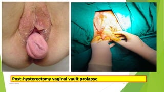Post-hysterectomy vaginal vault prolapse
Osama Warda 21
 