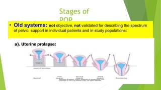 Stages of
POP
Osama Warda 24
• Old systems: not objective, not validated for describing the spectrum
of pelvic support in individual patients and in study populations:
a). Uterine prolapse:
 