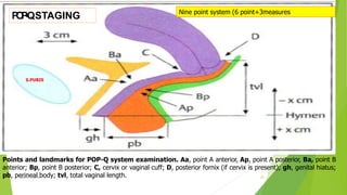 Points and landmarks for POP-Q system examination. Aa, point A anterior, Ap, point A posterior, Ba, point B
anterior; Bp, point B posterior; C, cervix or vaginal cuff; D, posterior fornix (if cervix is present); gh, genital hiatus;
pb, perineal body; tvl, total vaginal length.
Nine point system (6 point+3measures
Osama Warda 25
S.PUBIS
P
O
P
-
‐
QSTAGING
 