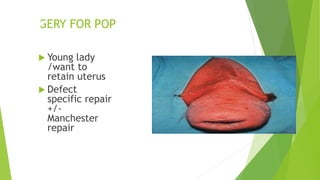 SURGERY FOR POP
 Young lady
/want to
retain uterus
 Defect
specific repair
+/-
Manchester
repair
 