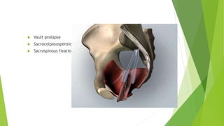  Vault prolapse
 Sacrocolposuspension
 Sacrospinous fixation
 