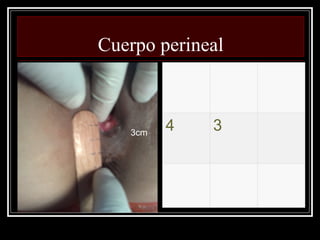 Cuerpo perineal



   3cm
         4   3
 