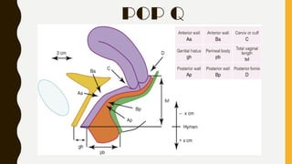 Comprehensive Guide to POP-Q Classification and Management of Pelvic ...