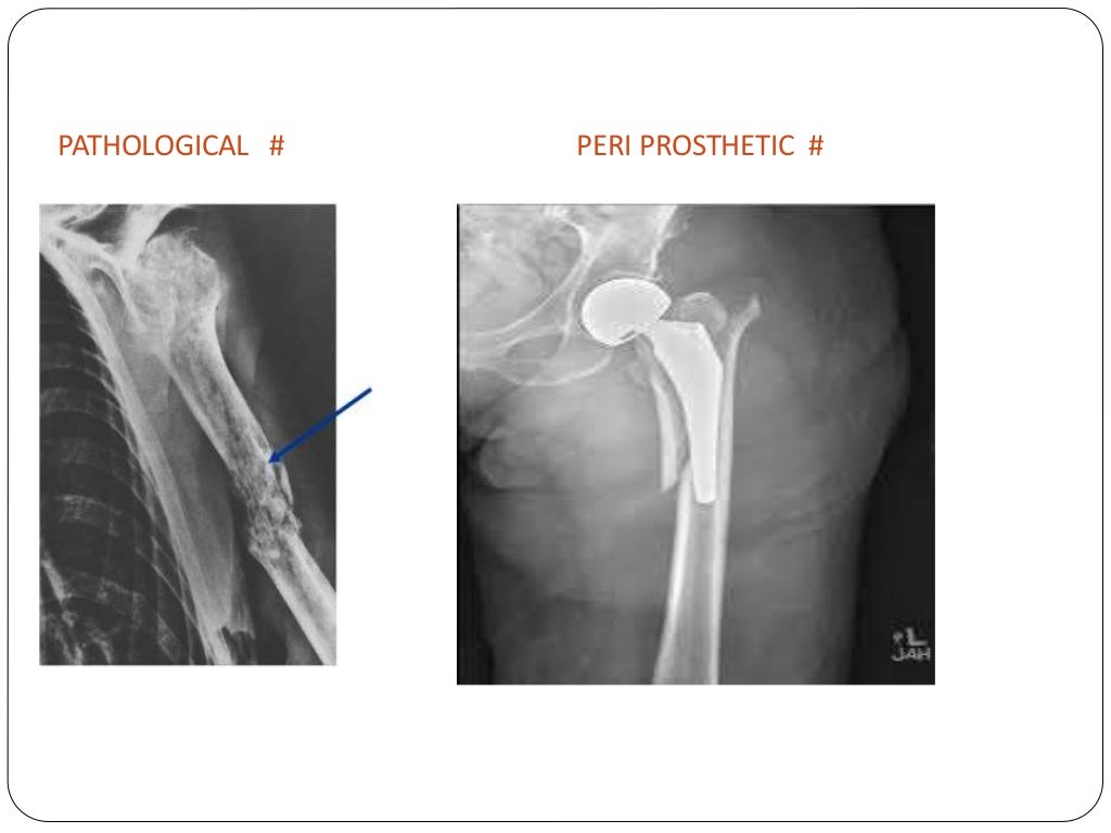 Fracture types Plaster Of Paris tecniques and Complications