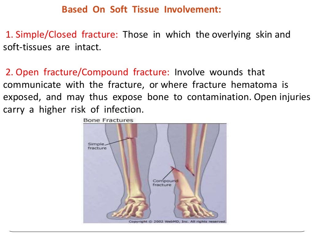 Fracture types Plaster Of Paris tecniques and Complications