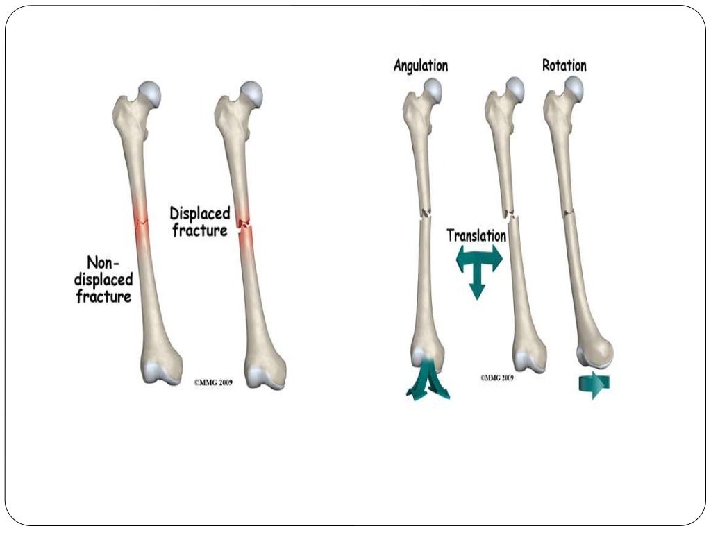 Fracture types Plaster Of Paris tecniques and Complications
