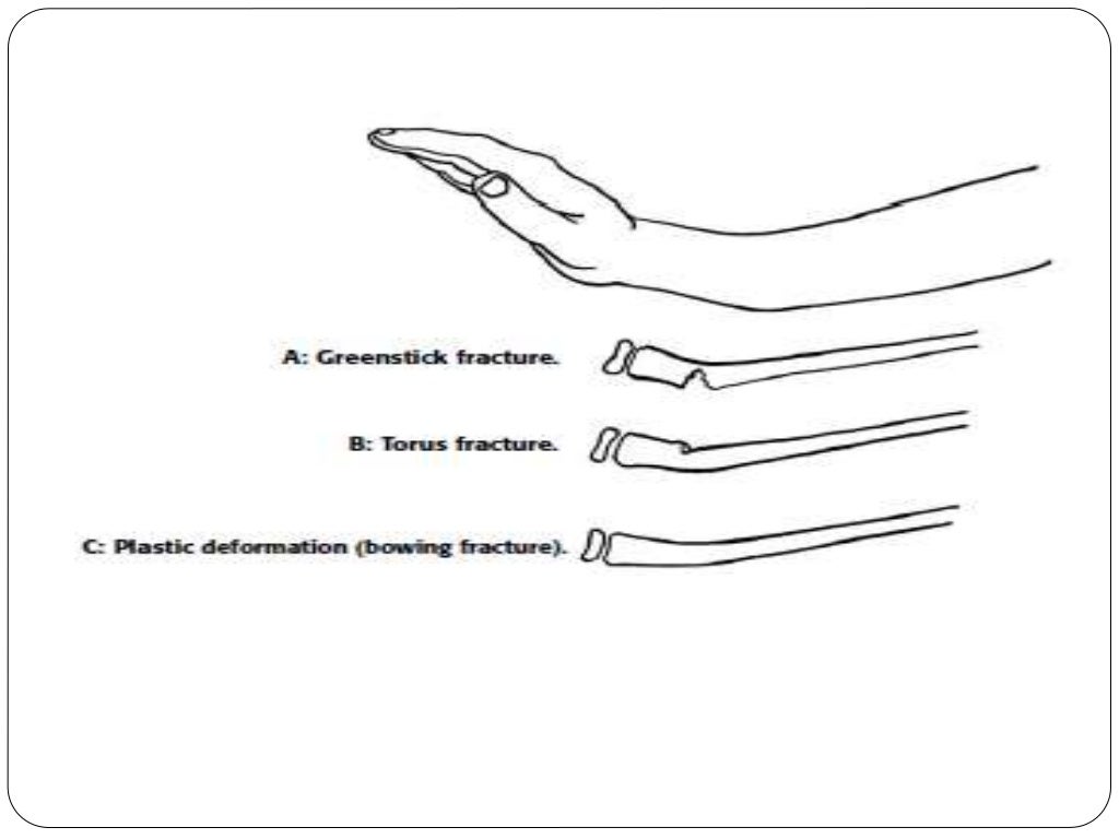 Fracture types Plaster Of Paris tecniques and Complications