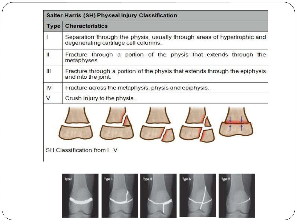Fracture types Plaster Of Paris tecniques and Complications