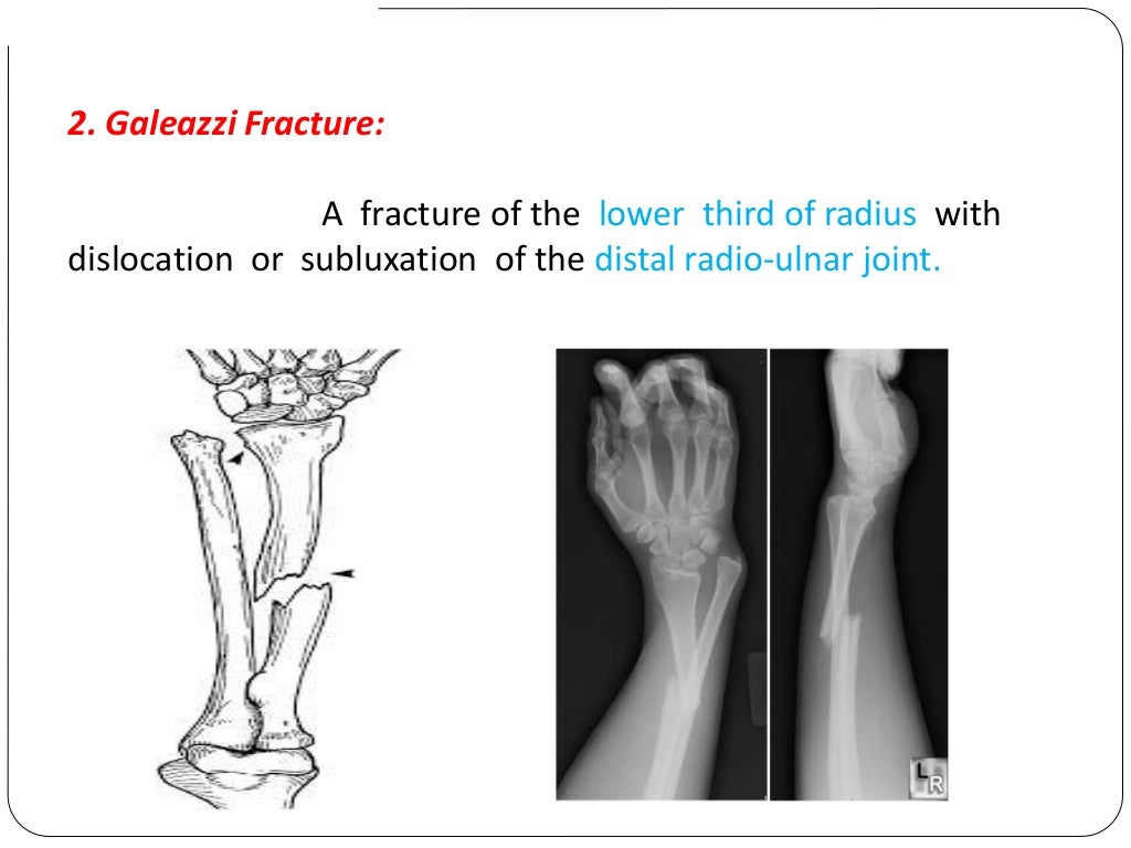 Fracture types Plaster Of Paris tecniques and Complications