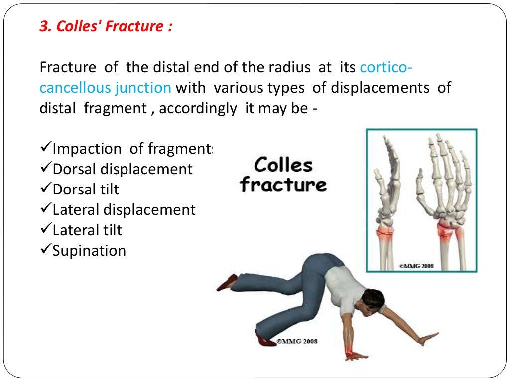 Fracture types Plaster Of Paris tecniques and Complications