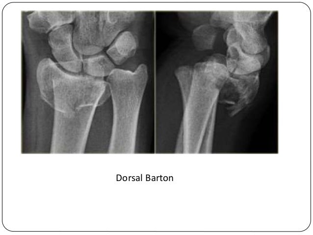 pilon fracture orif cpt pilon fracture orif cpt