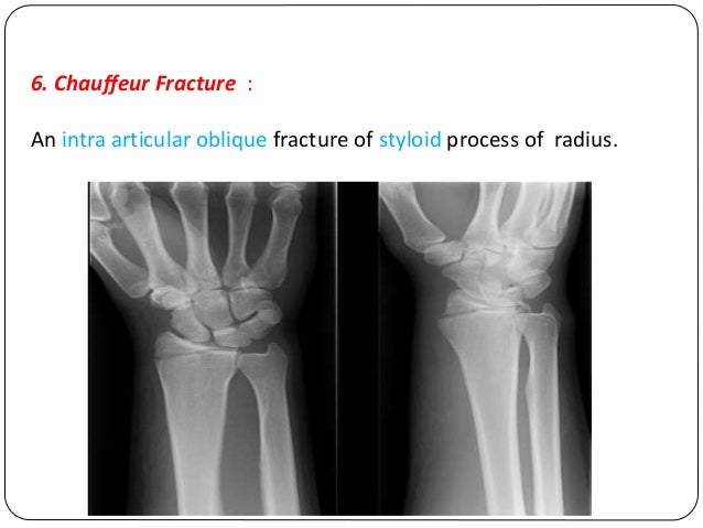 Fracture types - Plaster Of Paris tecniques and Complications