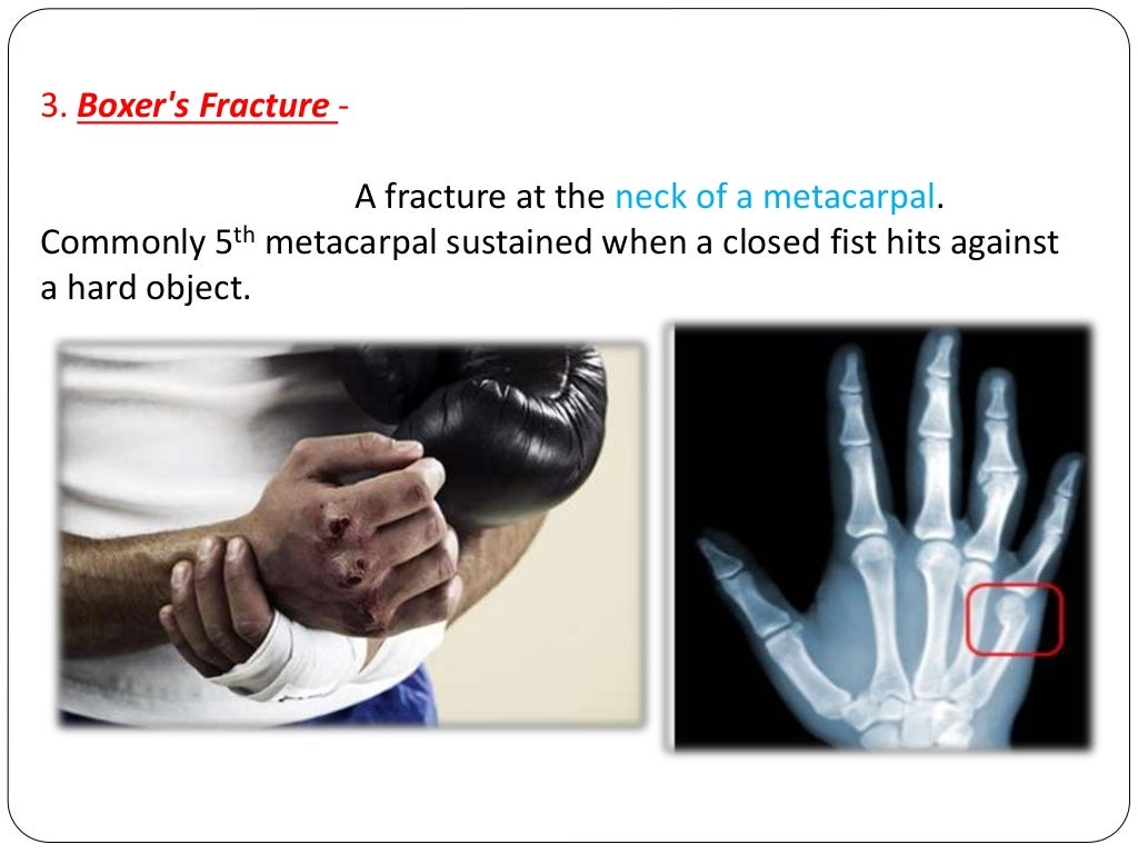 Fracture types Plaster Of Paris tecniques and Complications