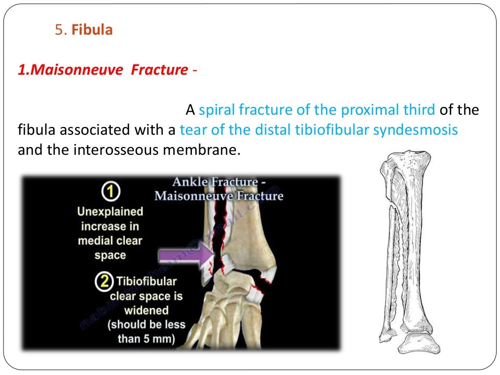 Fracture types Plaster Of Paris tecniques and Complications