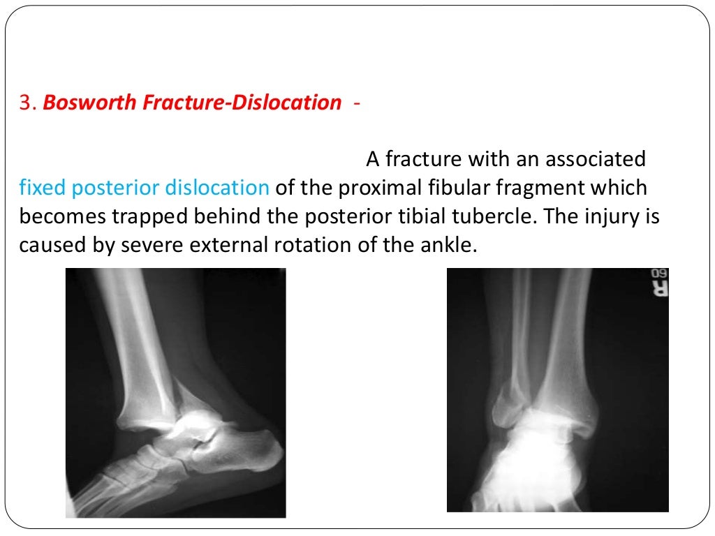 Fracture types Plaster Of Paris tecniques and Complications