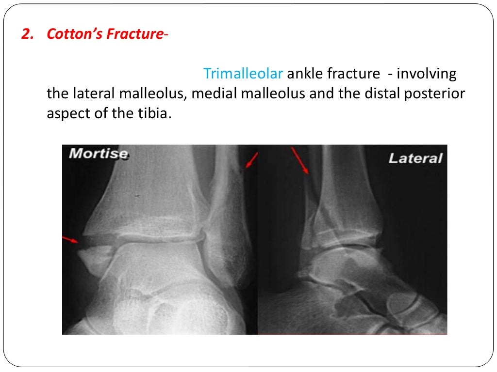Fracture types Plaster Of Paris tecniques and Complications