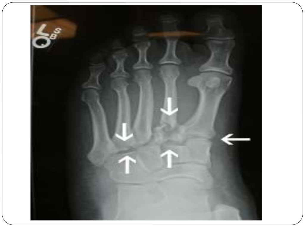 Fracture types Plaster Of Paris tecniques and Complications