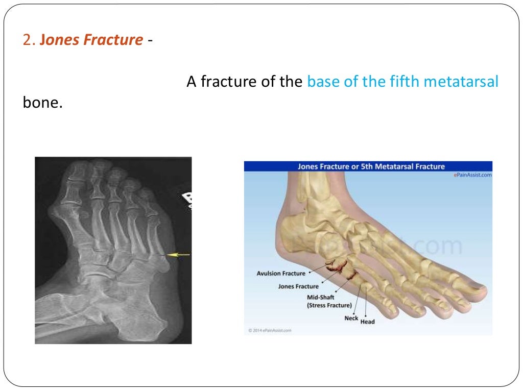 Fracture types Plaster Of Paris tecniques and Complications