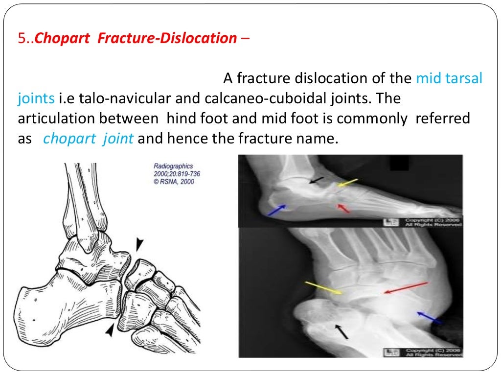 Fracture types Plaster Of Paris tecniques and Complications