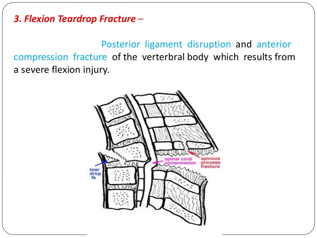Fracture types Plaster Of Paris tecniques and Complications