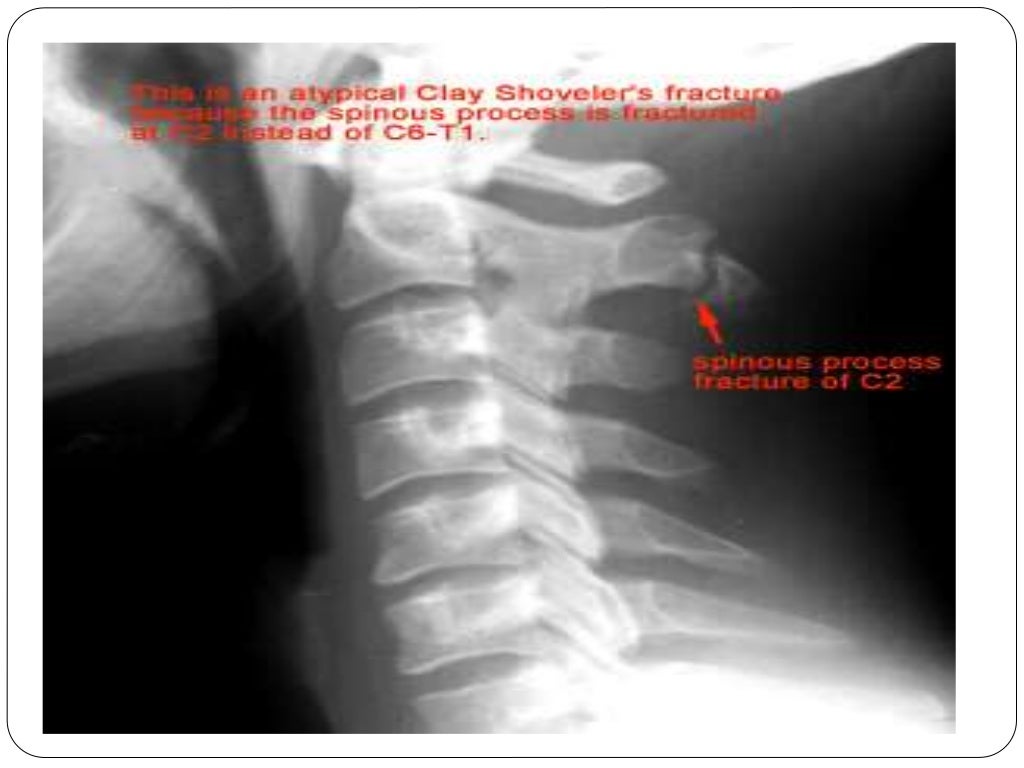 Fracture types Plaster Of Paris tecniques and Complications