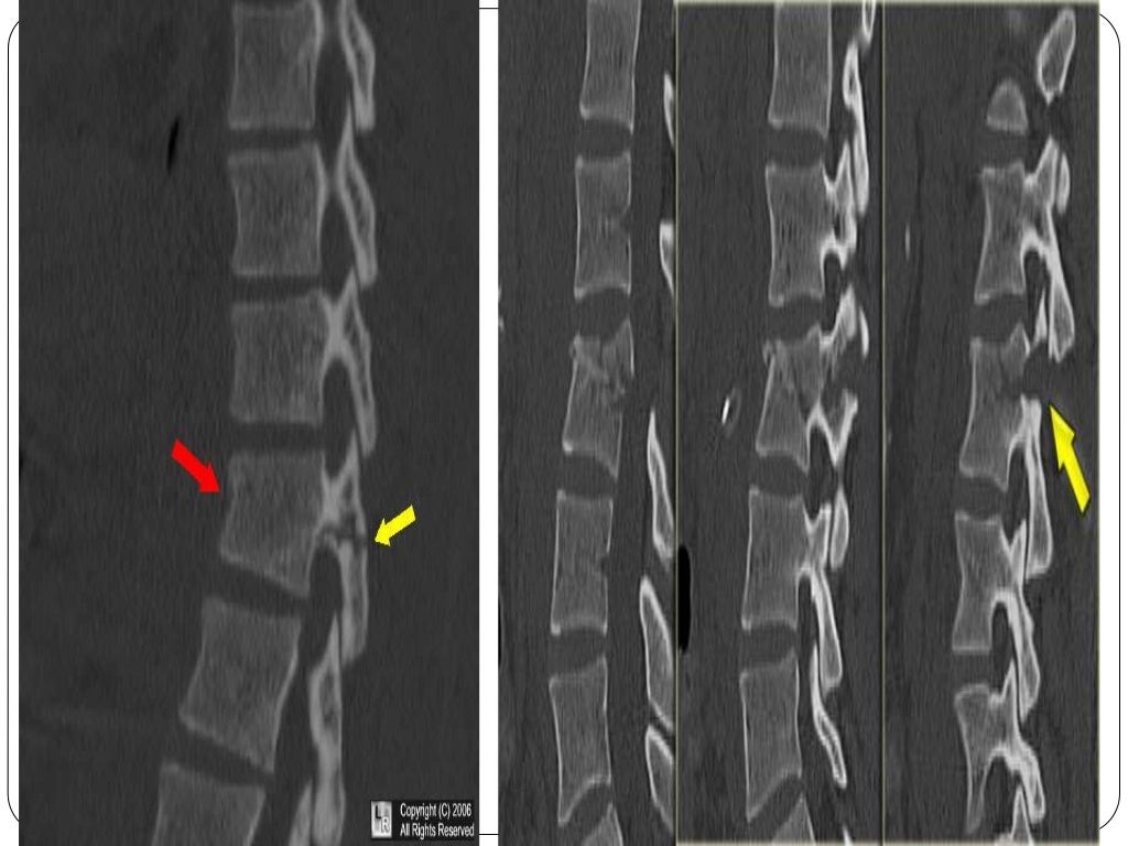 Fracture types Plaster Of Paris tecniques and Complications