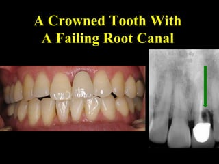 A Crowned Tooth With
A Failing Root Canal