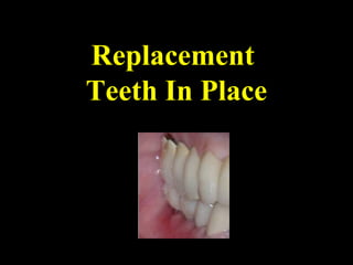 Replacement
Teeth In Place