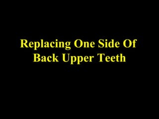 Replacing One Side Of
Back Upper Teeth