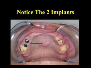 Notice The 2 Implants