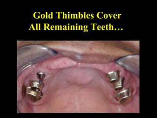 Gold Thimbles Cover
All Remaining Teeth…