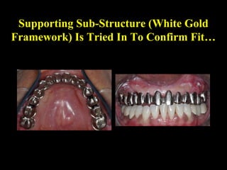 Supporting Sub-Structure (White Gold
Framework) Is Tried In To Confirm Fit…