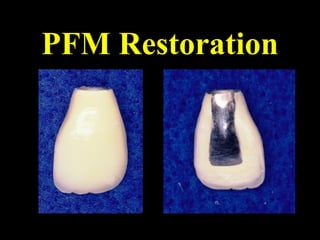 PFM Restoration