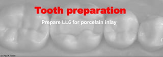 Dr. Paul A. Tipton
Prepare LL6 for porcelain inlay
Tooth preparation
 
