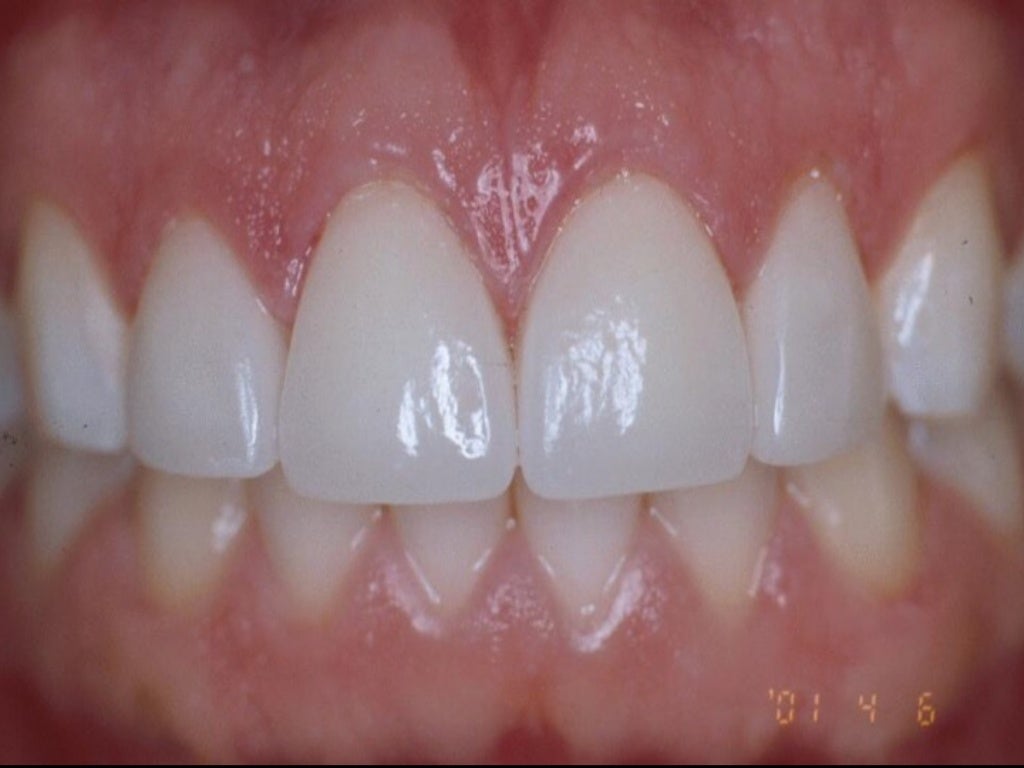 Porcelain Laminate Veneers Concepts and Techniques Col Douglas P.