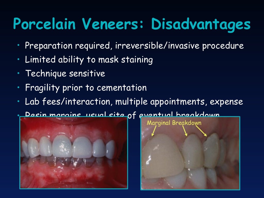 Porcelain Laminate Veneers Concepts and Techniques Col Douglas P.
