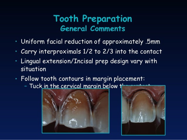 porcelain laminate veneers concepts and techniques col douglas p prep technique