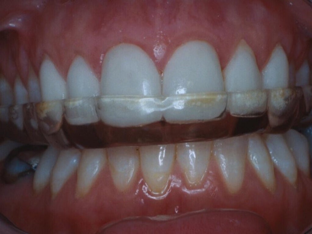 Porcelain Laminate Veneers Concepts and Techniques Col Douglas P.