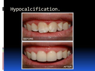 Hypocalcification.
 
