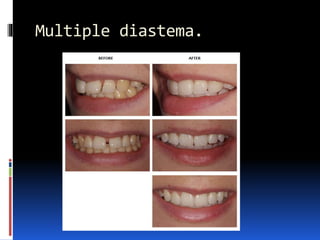 Multiple diastema.
 