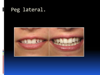Peg lateral.
 