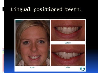 Lingual positioned teeth.
 
