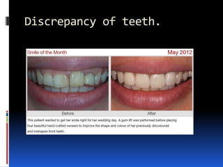 Discrepancy of teeth.
 