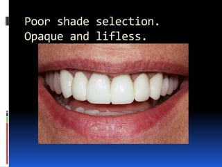 Poor shade selection.
Opaque and lifless.
 