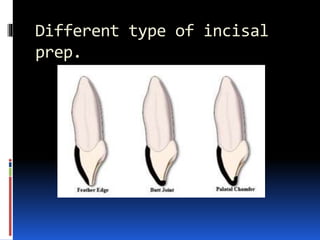 Different type of incisal
prep.
 