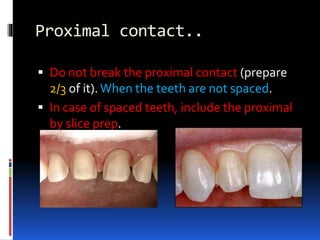 Proximal contact..
 Do not break the proximal contact (prepare
2/3 of it).When the teeth are not spaced.
 In case of spaced teeth, include the proximal
by slice prep.
 