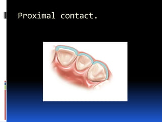 Proximal contact.
 