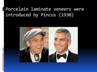 Porcelain laminate veneers were
introduced by Pincus (1930)
 