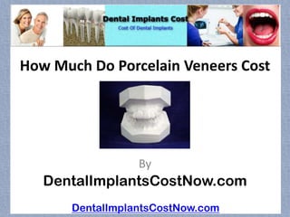 How Much Do Porcelain Veneers Cost




                  By
   DentalImplantsCostNow.com
       DentalImplantsCostNow.com
 