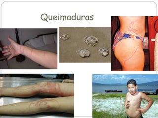 Queimaduras

 